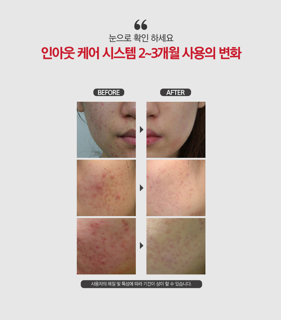 New AT Cream and Probiotics Lactobacillus MB01